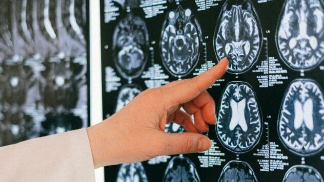 Neuralink випробує мозковий імплантат для читання думок і перекладу їх у текст стовбурові клітини після інсульта