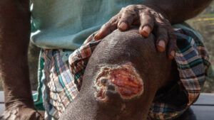 В Румынии зафиксировали проказу: Минздрав подтвердил заражение впервые за 44 года проказа, у Румунії зафіксували випадки прокази