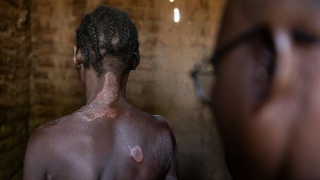 проказа (лепра)